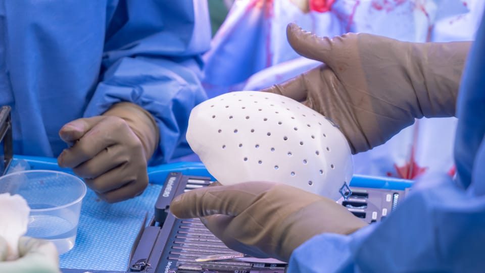Unispital Basel implantiert erstmals in Europa eine 3D-gedruckte Schädeldecke
