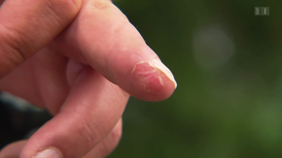 Nachwachsende Fingerglieder – Folienverband statt Operation