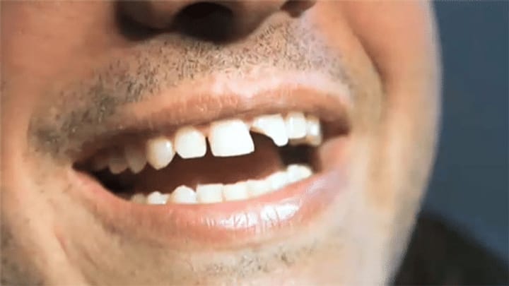Zahnschaden nach Kirschkonfi essen, Versicherung muss zahlen