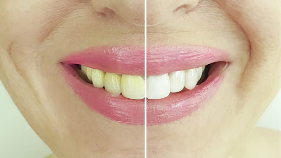 Zähne bleichen: Bleachen nur über den Zahnarzt sicher und wirksam