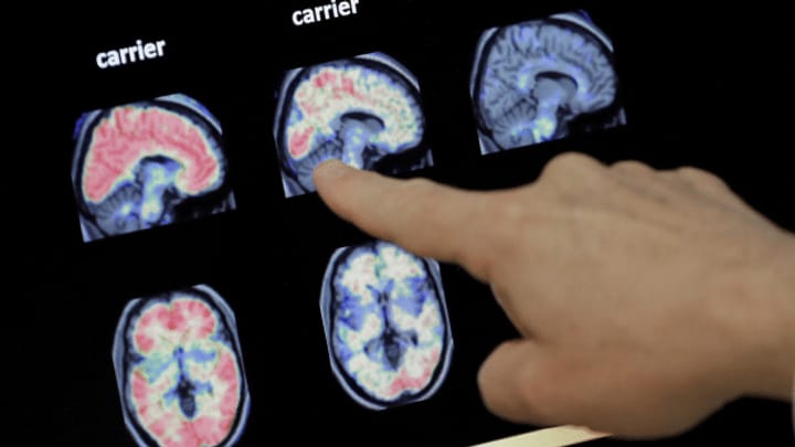 Archiv: Roche präsentiert enttäuschende Alzheimer-Studien