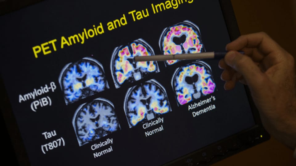 Studie zu Alzheimer-Medikament macht Hoffnung – zu Recht?
