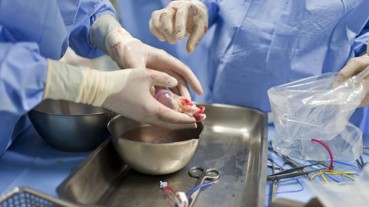 US-Ärzte transplantieren genmanipuliertes Schweineherz