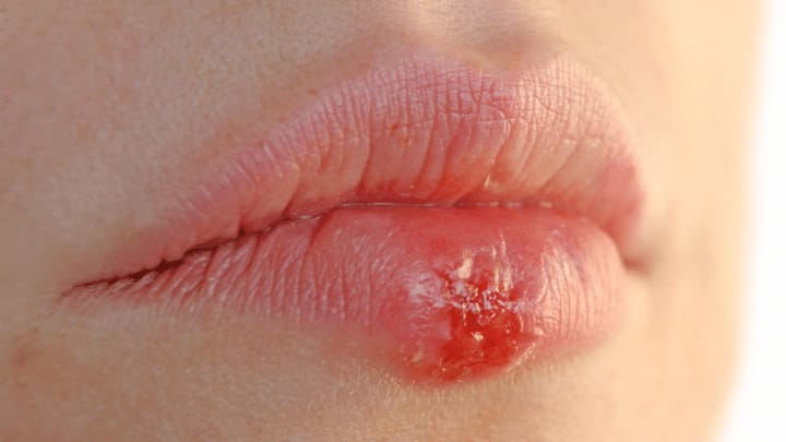 Lippenherpes ist weit verbreitet