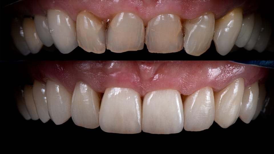 Veneers, Bleaching und Co. – Der hohe Preis perfekter Zähne