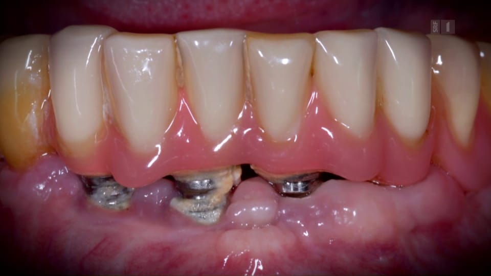 Zahnimplantate: Immer der Zahnersatz der Wahl?