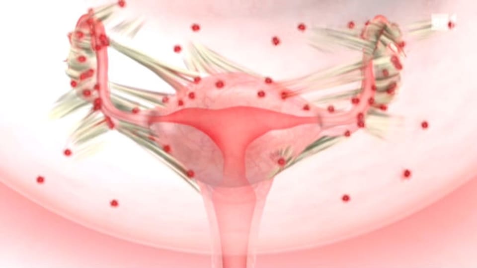 Endometriose - Wenn der Schmerz kaum noch zu ertragen ist