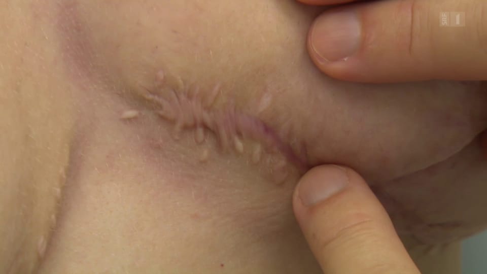 Pfusch bei Brust-OP: Schönheitschirurg verunstaltet Patientin