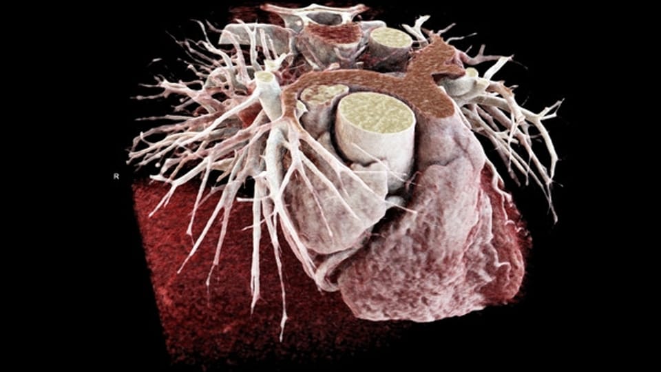 Blick ins Herz – Kardio-CT statt invasivem Herz-Katheter