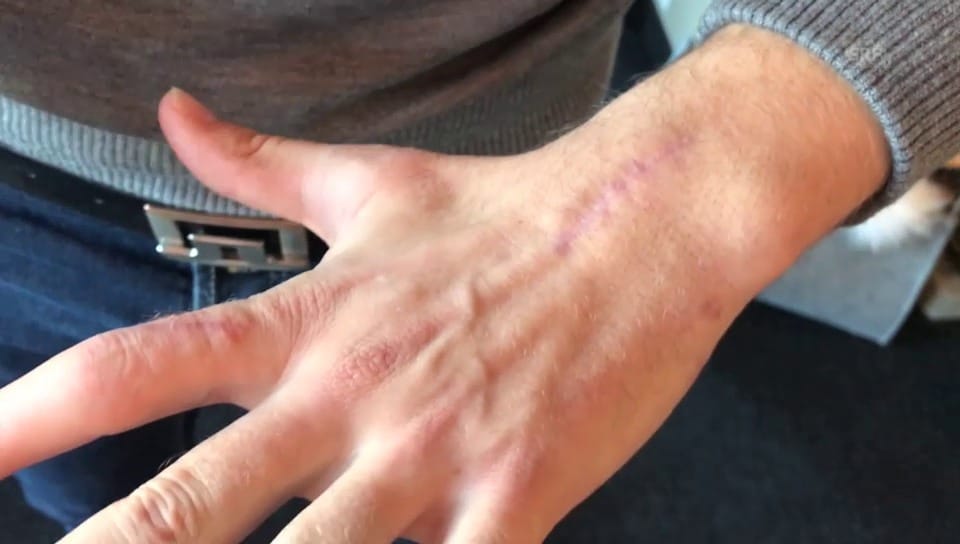Mauro Caviezels Hand vier Monate nach dem Unfall