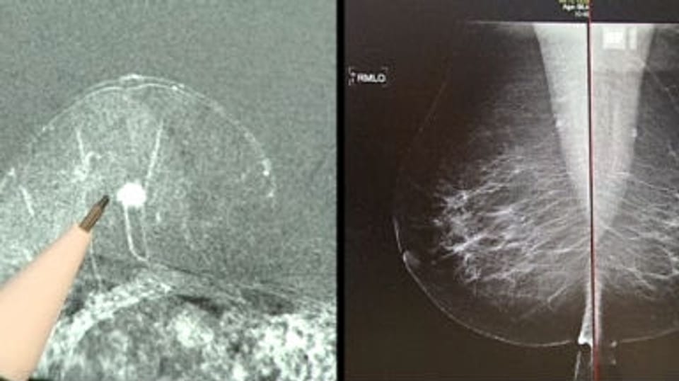 MRI statt Mammografie – Wieso noch nicht im Einsatz?