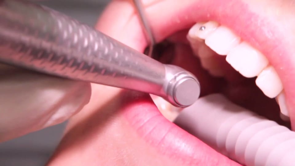 Zahnarzt-Pfusch: Mund nach Eingriff taub