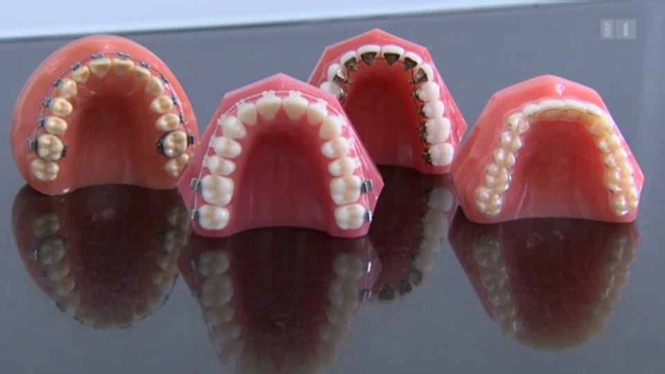 Immer mehr Erwachsene tragen Zahnspange
