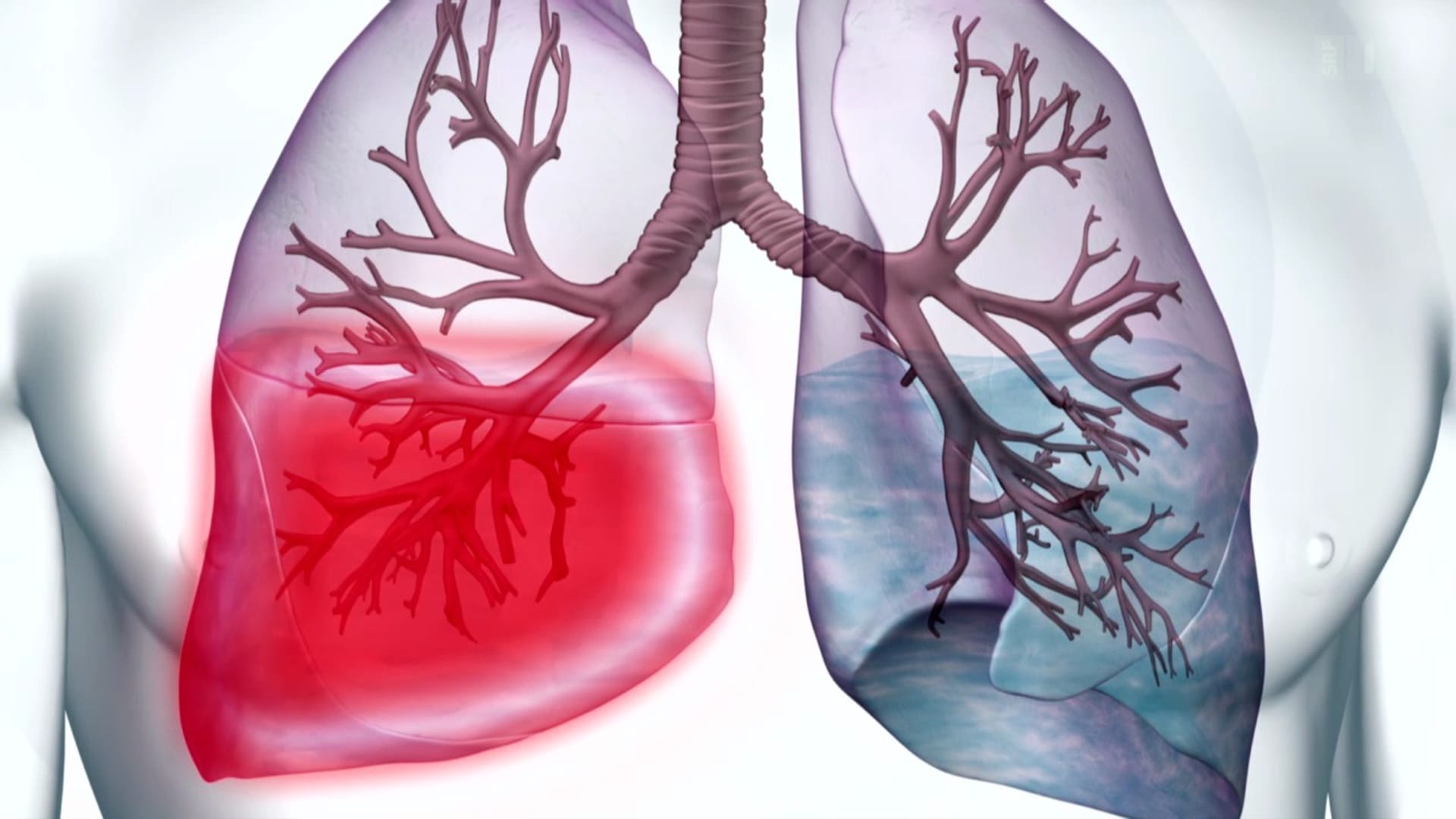 Puls - Risiko Lungenentzündung - Play SRF