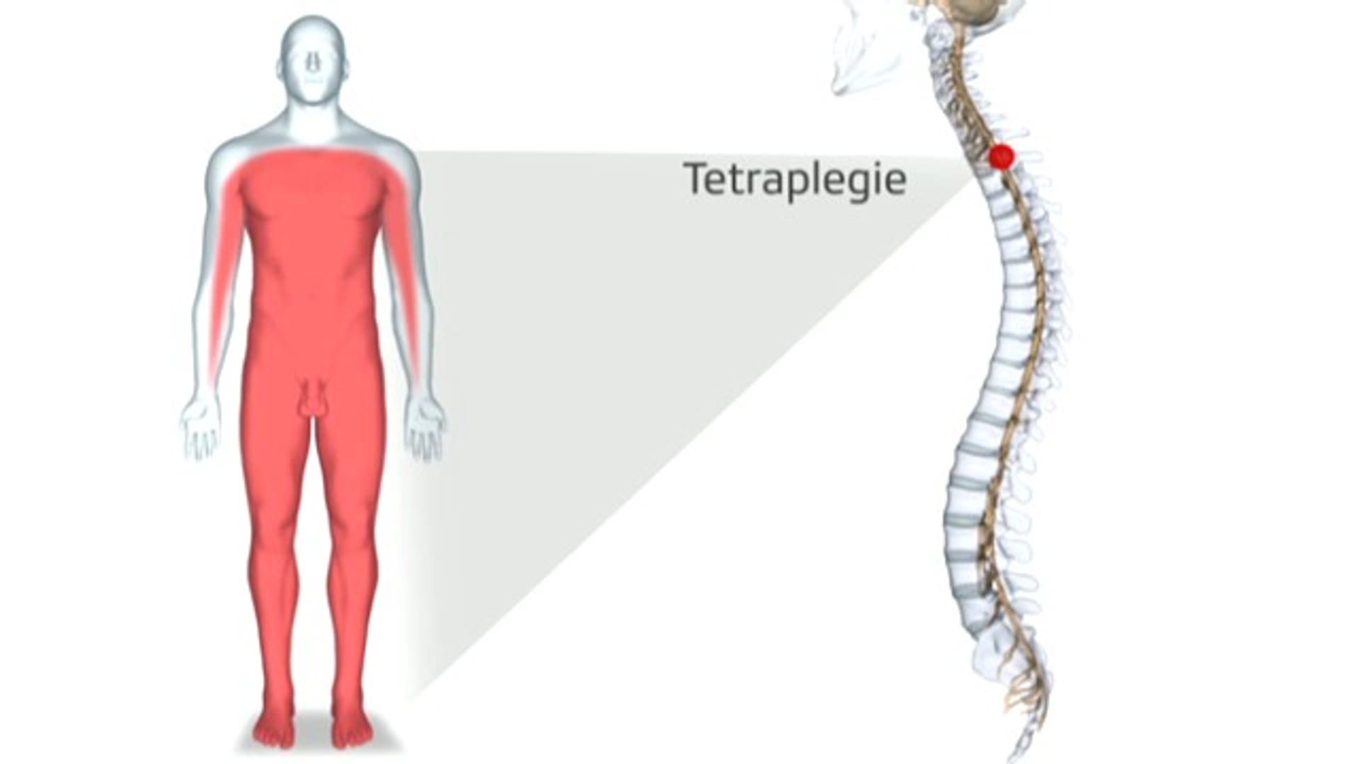 Puls - Querschnittlähmung ist nicht gleich Querschnittlähmung - Play SRF